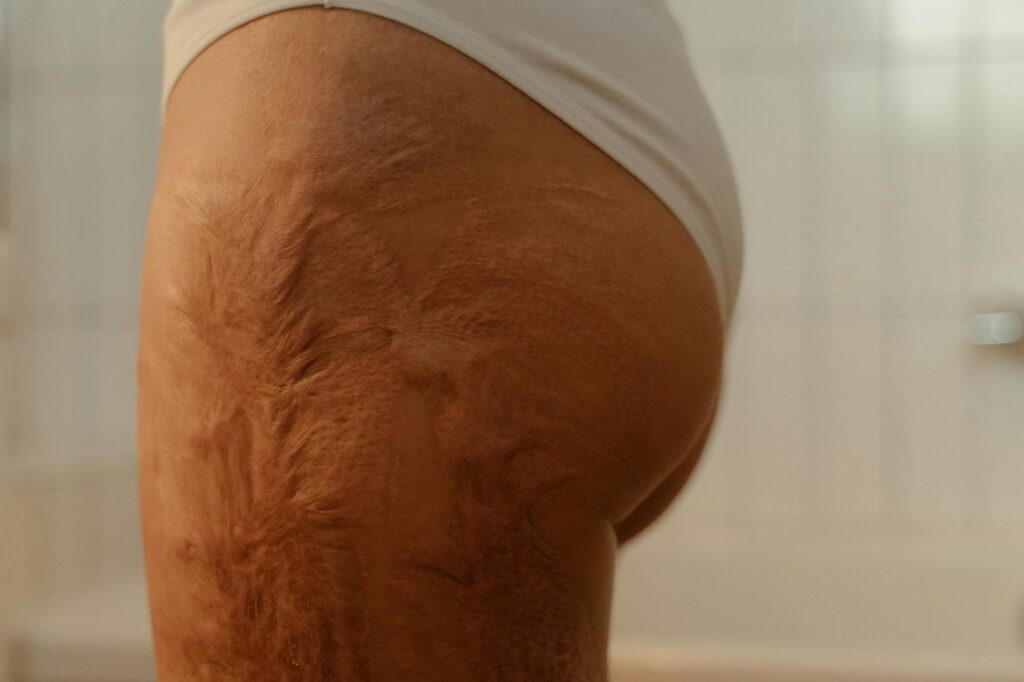 skin chafing prevention