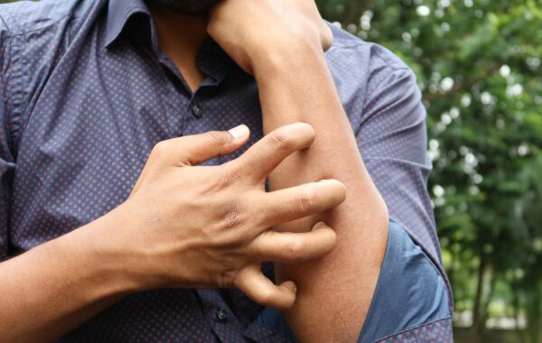 Piçada: Your Practical Guide to Skin Comfort & Management